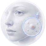 Acne verwijdering